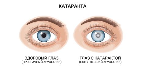 Симптомы жировика у глаза