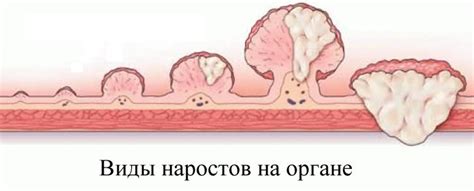 Симптомы и диагностика полипов