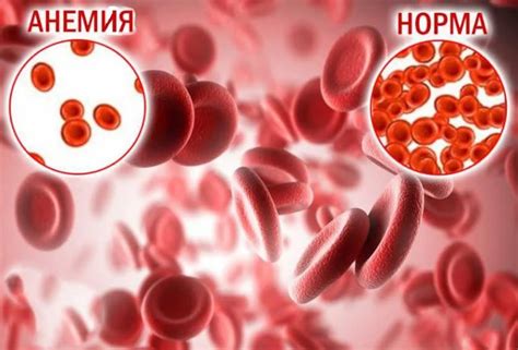 Симптомы и признаки переизбытка железа