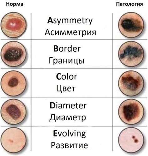 Симптомы и признаки родинки черного цвета
