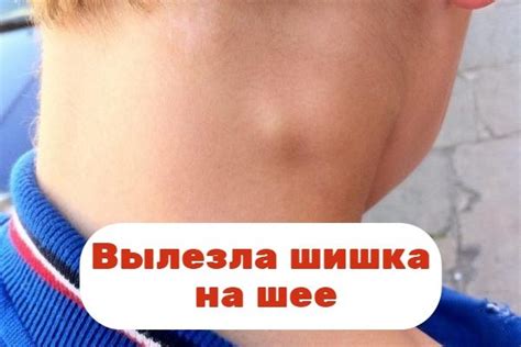 Симптомы и причины возникновения шишки на шее