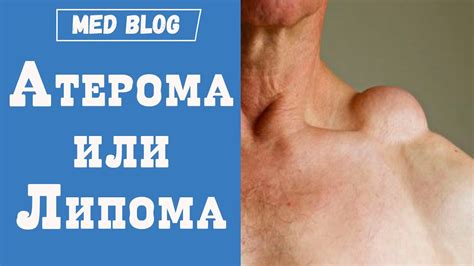 Симптомы и причины липомы на шее
