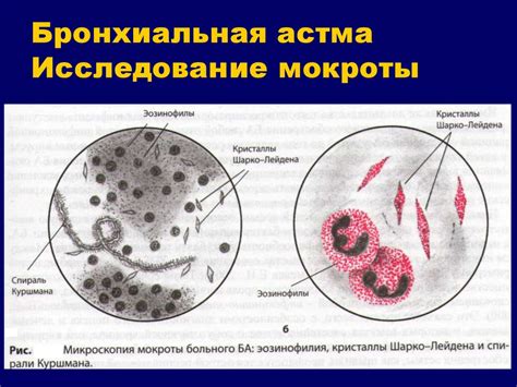 Симптомы образования и выделения мокроты при бронхиальной астме