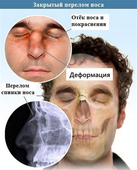Симптомы перелома носа