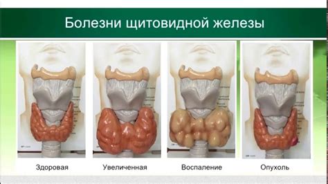 Симптомы повышенного давления от щитовидной железы