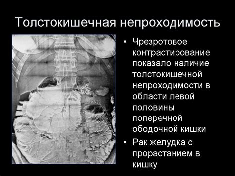 Симптомы при непроходимости нефростомы