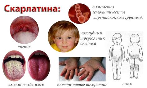 Симптомы скарлатины