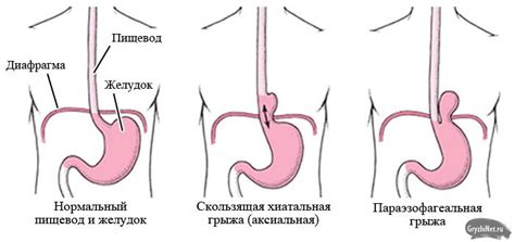 Симптомы хиатальной грыжи