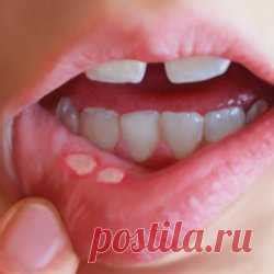 Симптомы язвы во рту