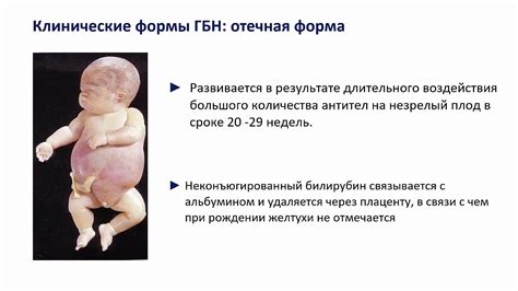 Синдром гемолитической болезни новорожденных