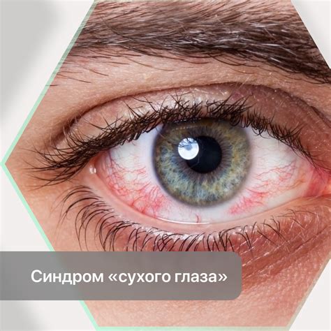 Синдром сухого глаза в связи с недостаточной увлажненностью
