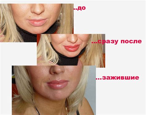 Снизить риск отека и побледнения губ