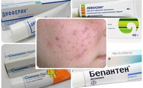 Способы лечения прыщей на плечах у подростков