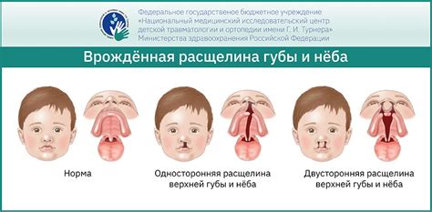 Способы лечения трескавшейся нижней губы у ребенка