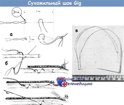 Способы облегчения жжения шва