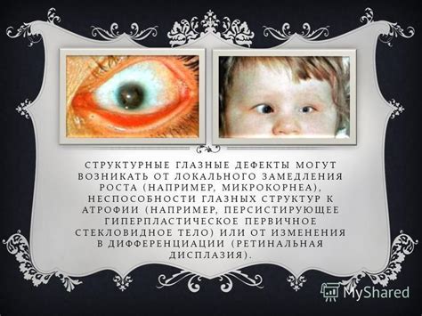Старение глазных структур