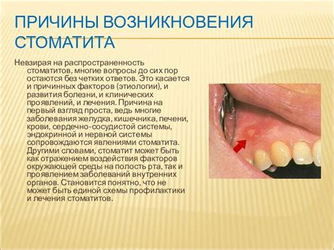Стоматит: основные причины возникновения