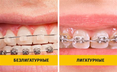 С чего начать и чем стоит заменить брекеты на время заживления