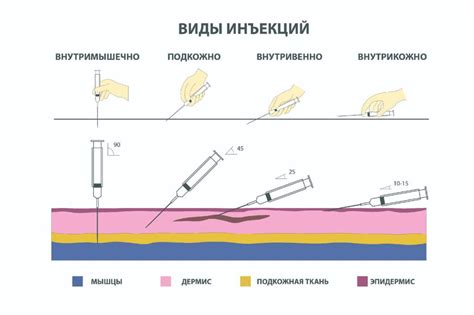 Техника подкожной инъекции: шаги и практические рекомендации