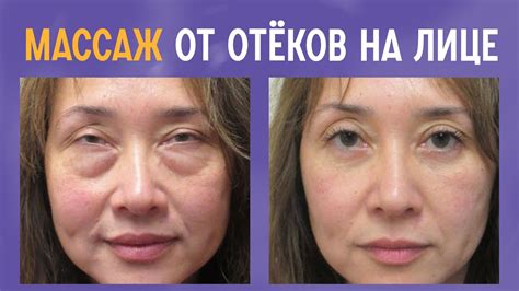 Техники массажа для снятия отека
