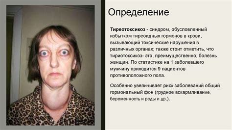 Тиреотоксикоз: