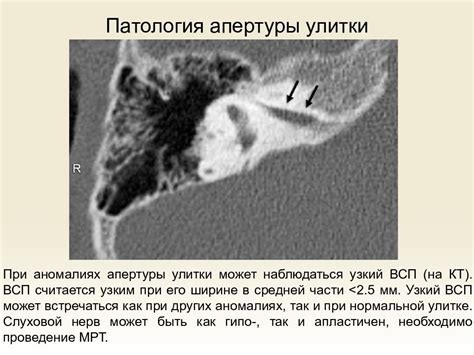 Томография внутреннего уха