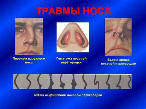 Травма носа: