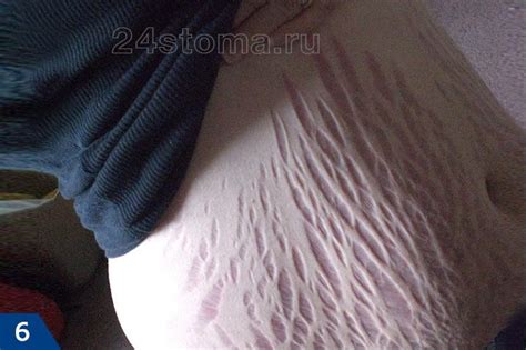 Убрать растяжки на животе после родов