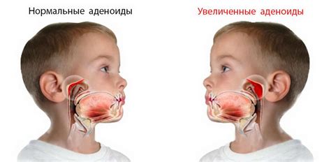 Удаление аденоидов у ребенка