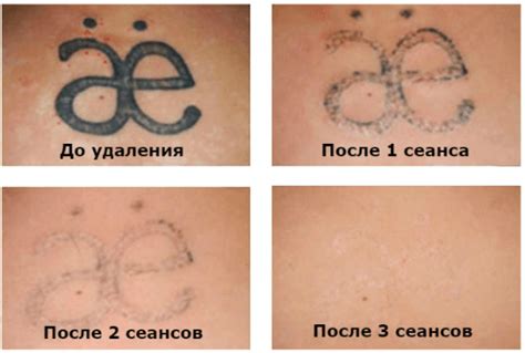 Удаление временной татуировки: