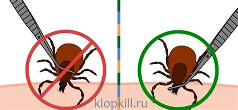 Удаление клеща с использованием пинцета