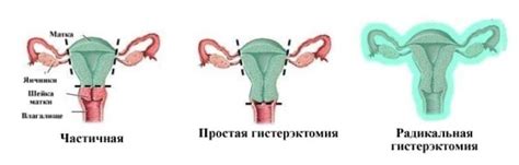 Удаление матки: методы и последствия