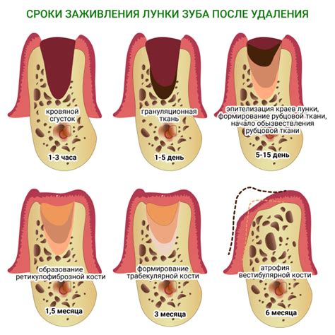 Удаление острых краев после открытия ампулы