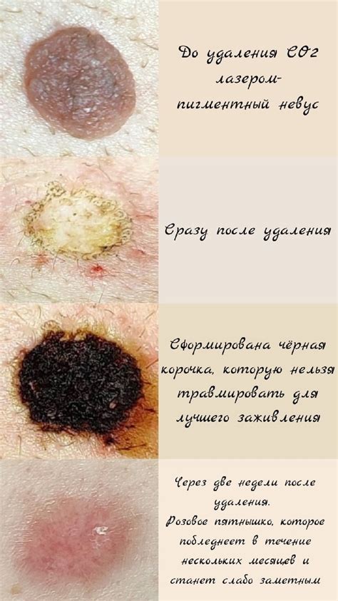 Удаление родинки лазером: основные преимущества