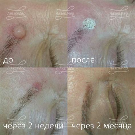 Удаление фибромы при помощи химических средств