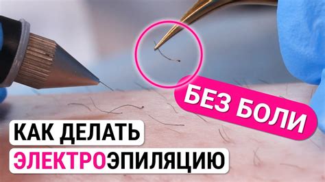 Узнайте, как часто нужно проводить электроэпиляцию
