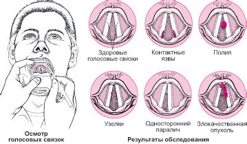 Укрепление голосовых связок