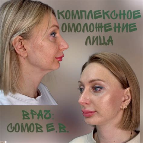 Улучшение внешнего вида щек