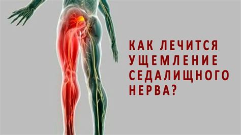 Улучшение состояния седалищного нерва