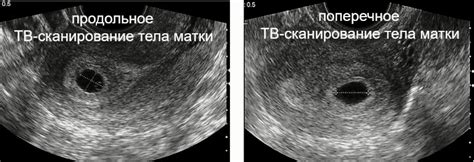 Ультразвуковое исследование: определение срока беременности