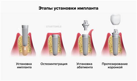 Установка и фиксация перекладин