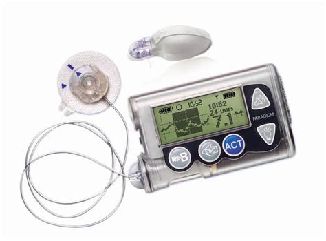 Установка помпы Medtronic 754