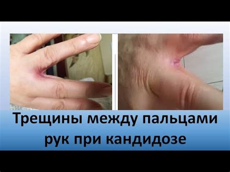 Устранение зуда между пальцами на руках