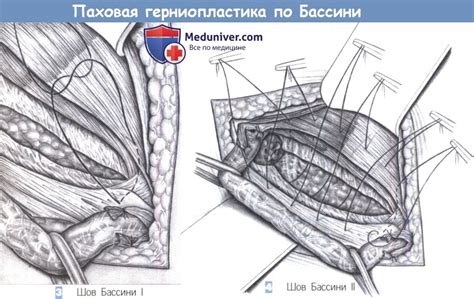 Устранение паховой грыжи: основные этапы и преимущества