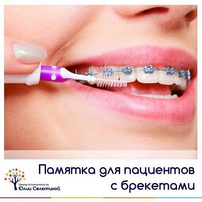 Уход за домашними брекетами