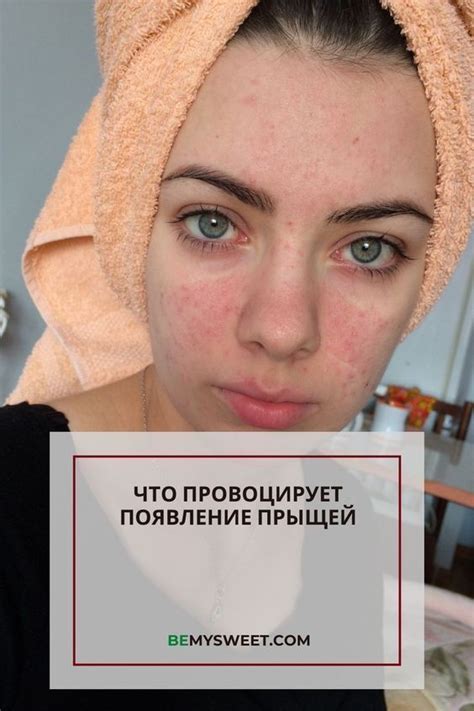 Уход за кожей: как избавиться от прыщей