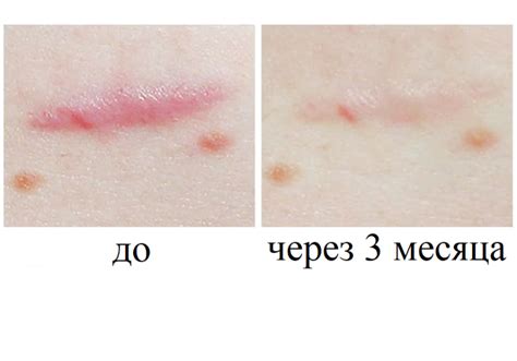 Уход за ранами для предотвращения образования рубцов