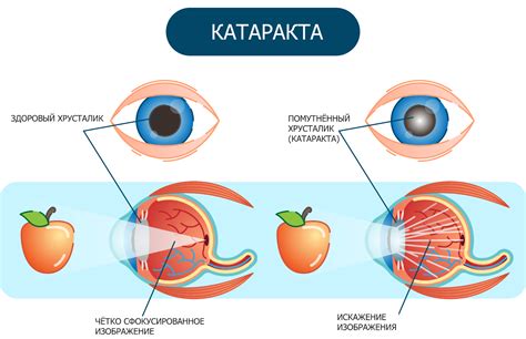 Факторы и симптомы катаракты