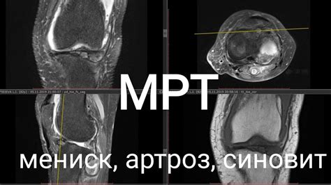 Физическая активность после операции мениска
