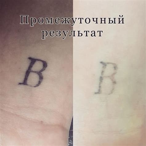 Химический метод удаления игольчатой татуировки